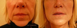 Hyaluronic Acid acide hyaluronique injections