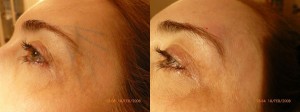 acide hyaluronique injections - Hyaluronic Acid